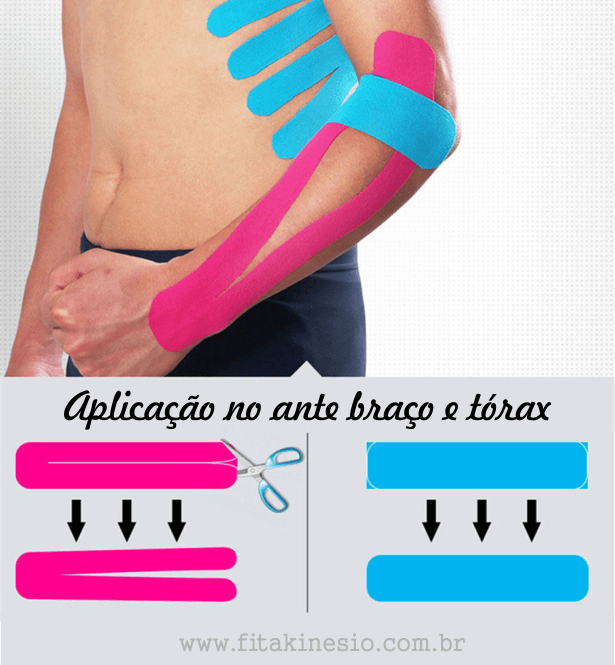 Exemplo de aplicação no ante braço e tórax da bandagem kinesio